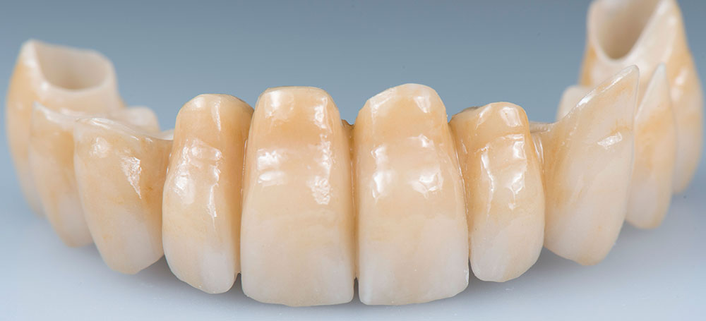 Circolare in zirconia realizzazione Cad-Cam